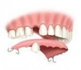 /album/prosthodontics/prosthodontois-2-jpg/